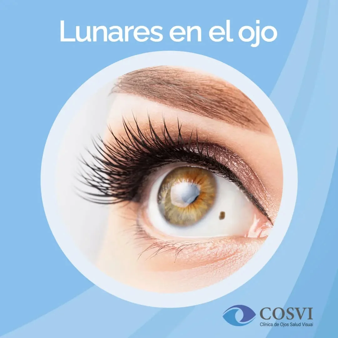 Control Preventivo de Nevus Ocular (Lunares)